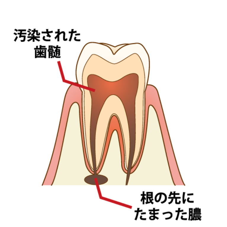 嚢胞摘出手術を行った後も、PRPを使用して傷の治りを促進します